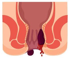 انتشار داء البواسير